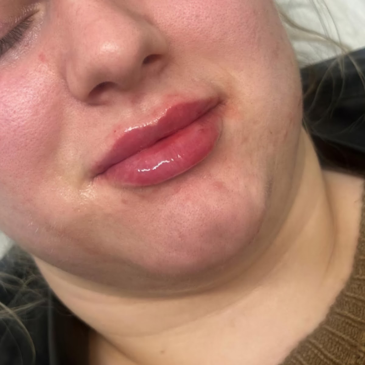 Soft, natural lip result after treatment at Ace of Face